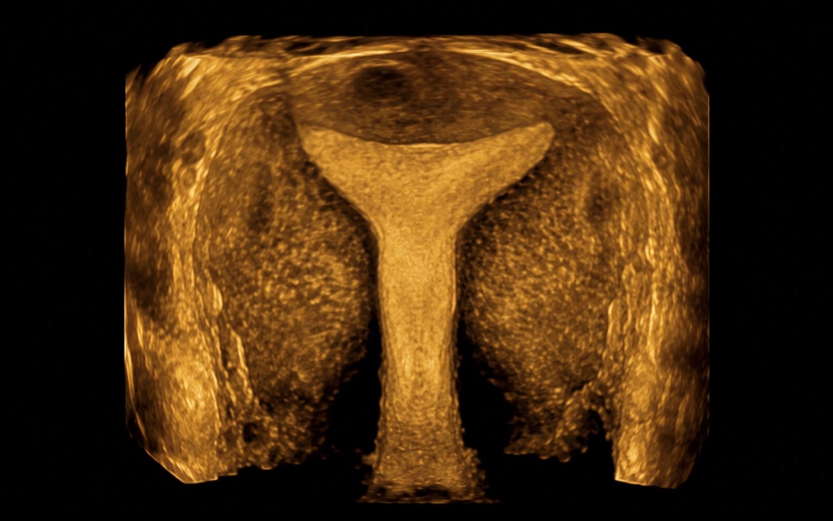 A Importância da ultrassonografia transvaginal 3D na infertilidade e abortamento de repetição