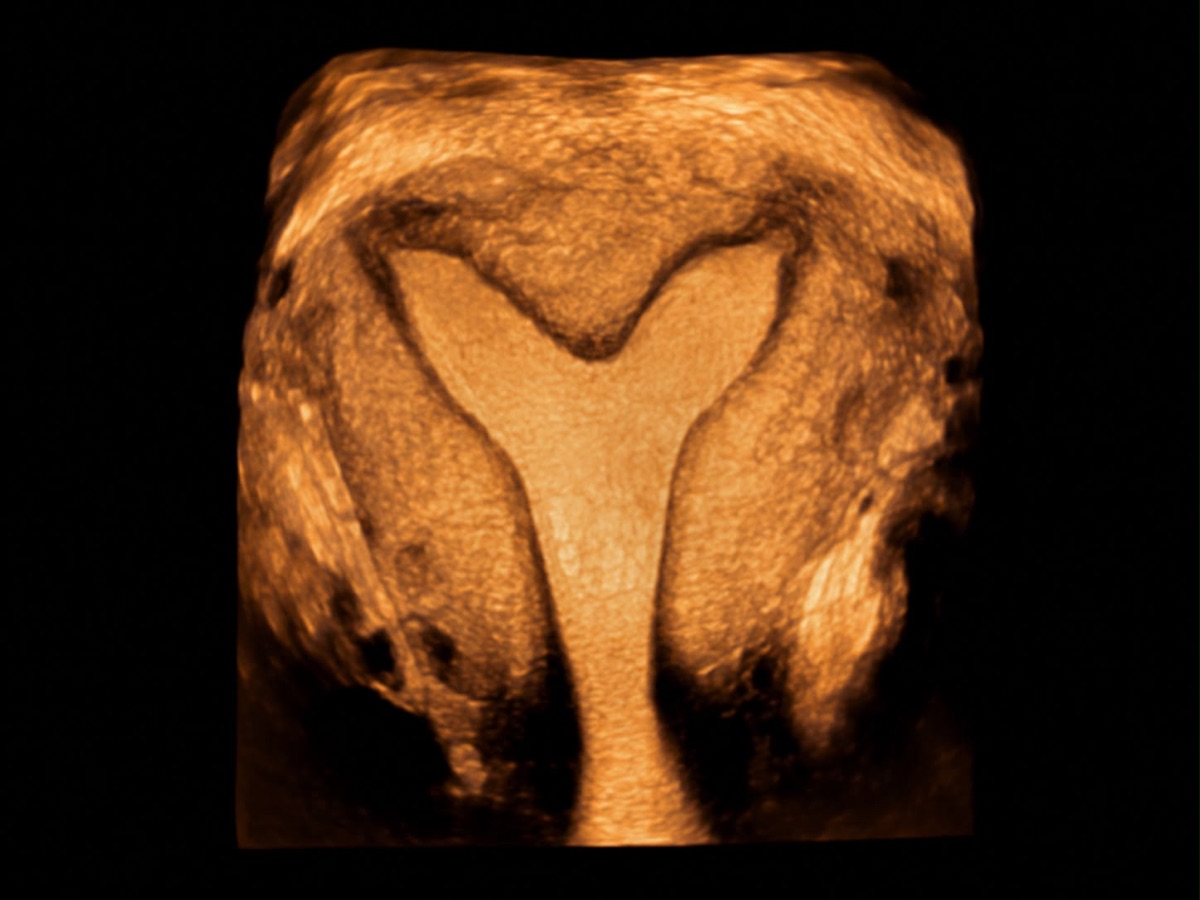 A importância da ultrassonografia transvaginal 3D no diagnóstico das malformações uterinas
