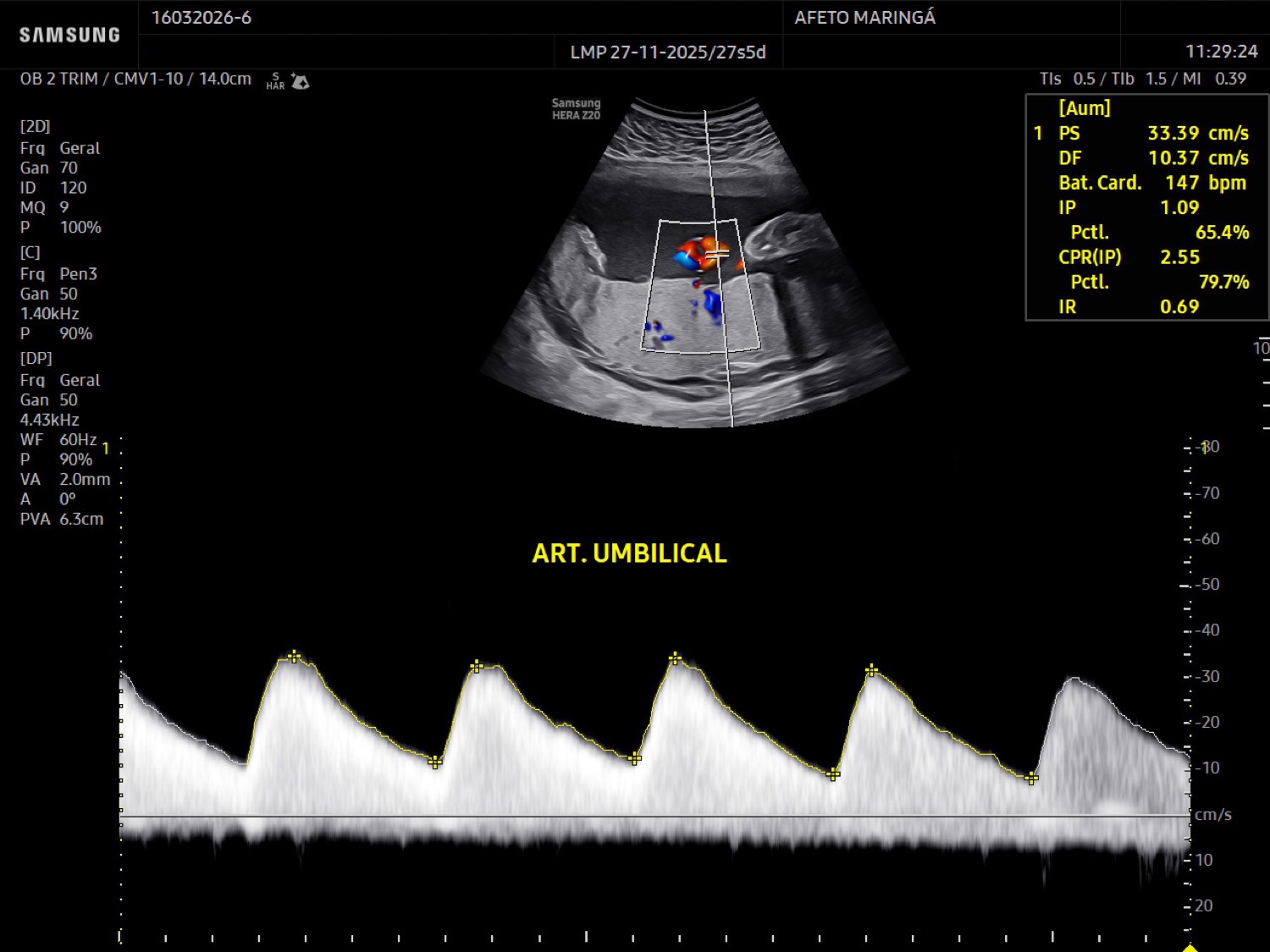 Doppler obstétrico em Maringá: para que serve e como interpretar os resultados na gestação.