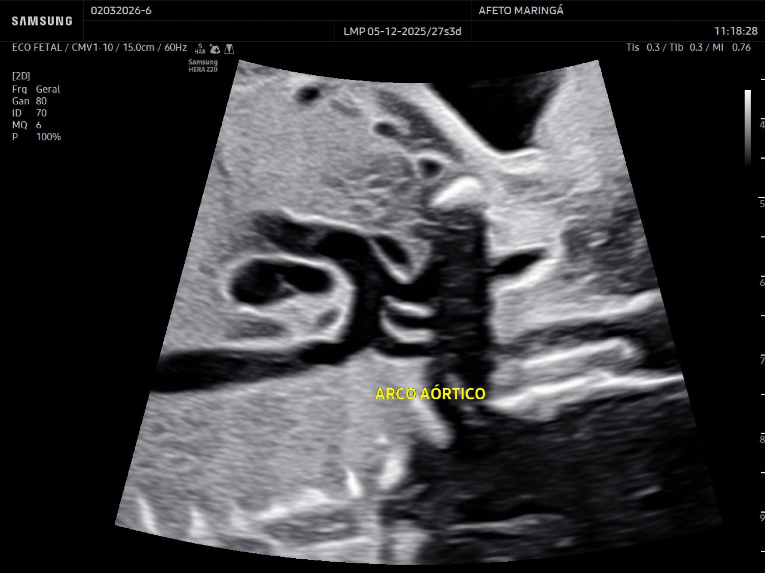 Ecocardiograma fetal em Maringá: para que serve, quando fazer e quem precisa do exame