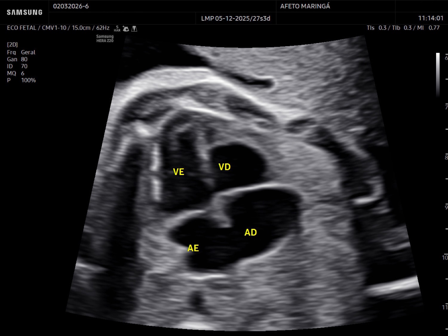 O ecocardiograma fetal avalia a anatomia do coração, as válvulas, o fluxo sanguíneo e o ritmo cardíaco do bebê.