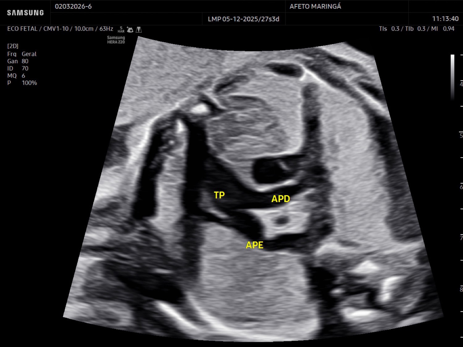 O ecocardiograma fetal avalia a anatomia do coração, as válvulas, o fluxo sanguíneo e o ritmo cardíaco do bebê.