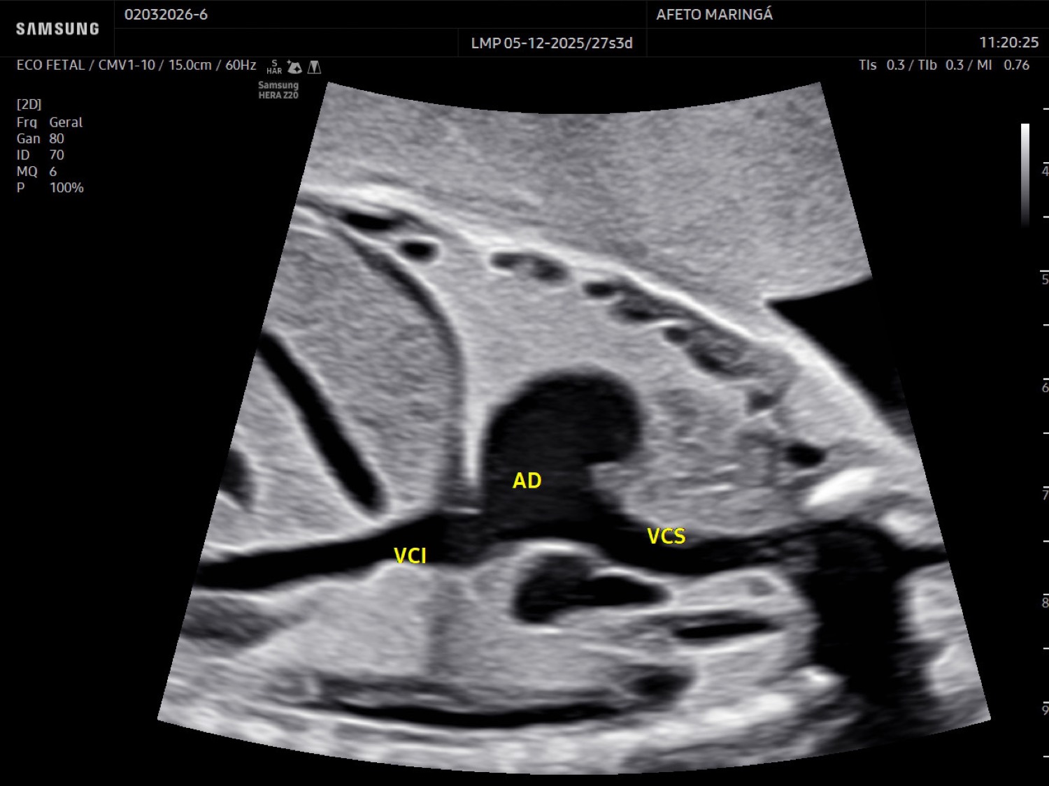 O ecocardiograma fetal avalia a anatomia do coração, as válvulas, o fluxo sanguíneo e o ritmo cardíaco do bebê.