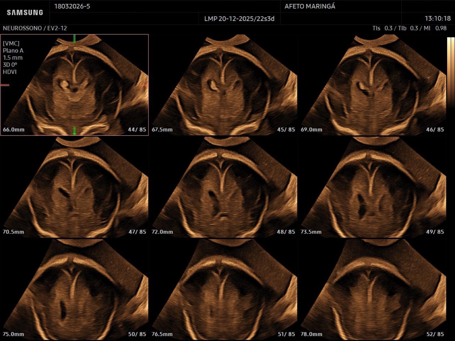 Reconstrução multiplanar do volume tridimensional do encéfalo fetal durante a neurossonografia.