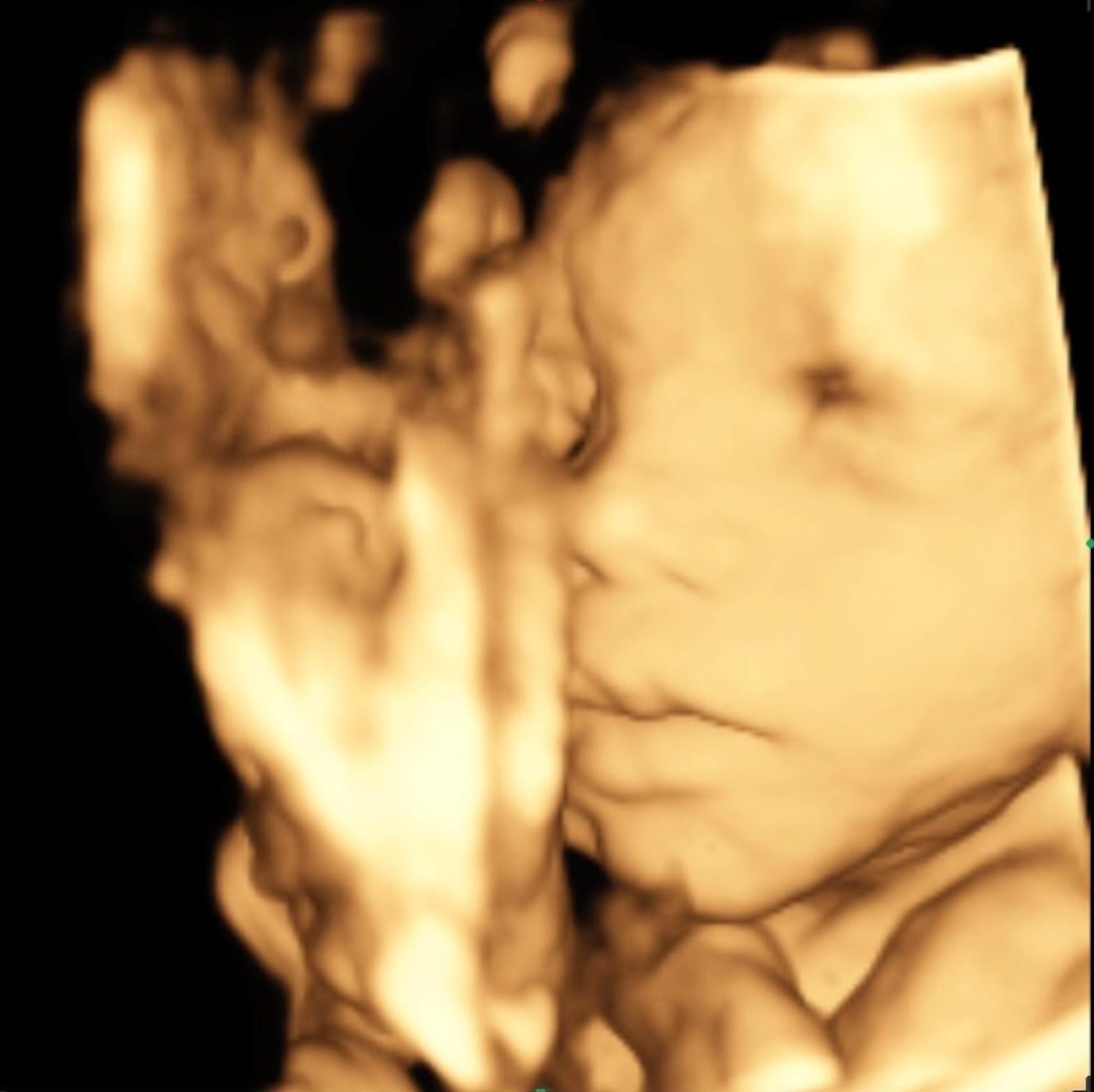 Imagem em 3D, mostrando superfícies e contornos do bebê.