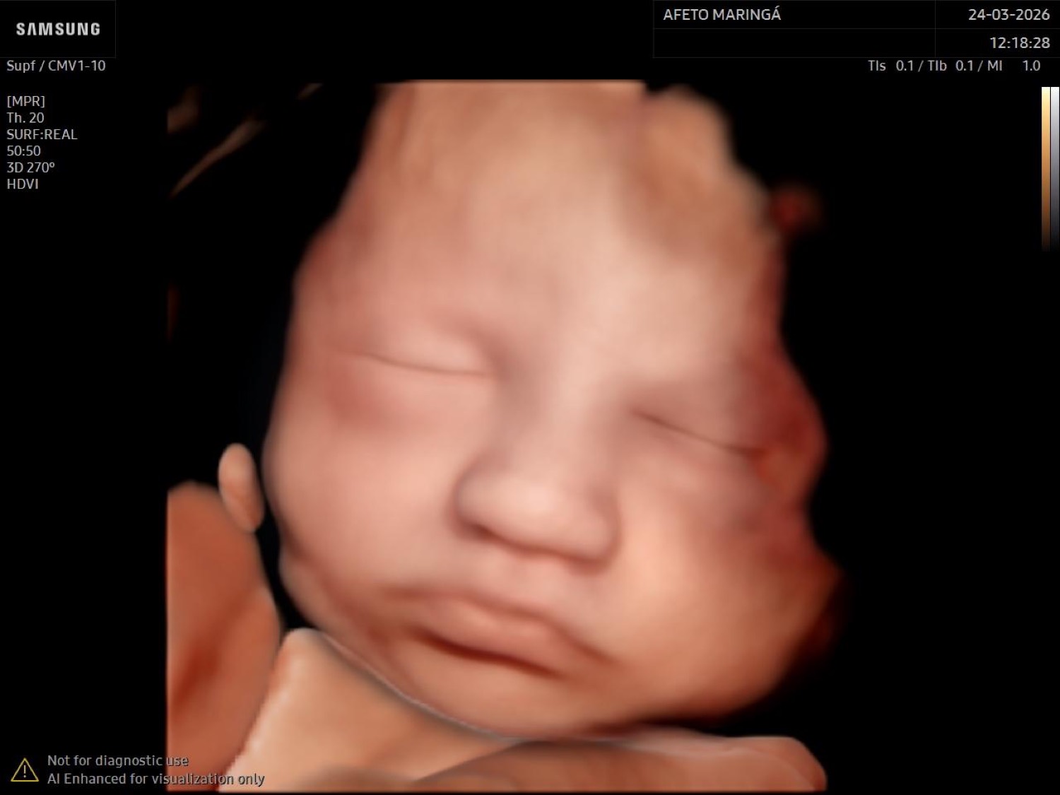 Ultrassom 8D com Inteligência Artificial em Maringá: tecnologia BabyFace e como ver o rosto do bebê com mais realismo