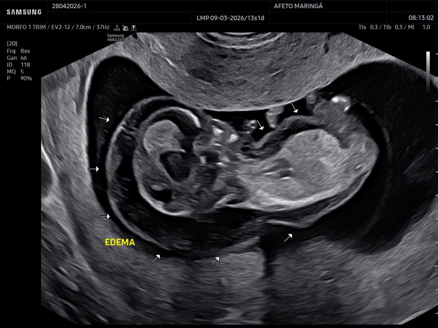 Ultrassonografia fetal e exames genéticos: quando o bebê precisa de investigação genética?