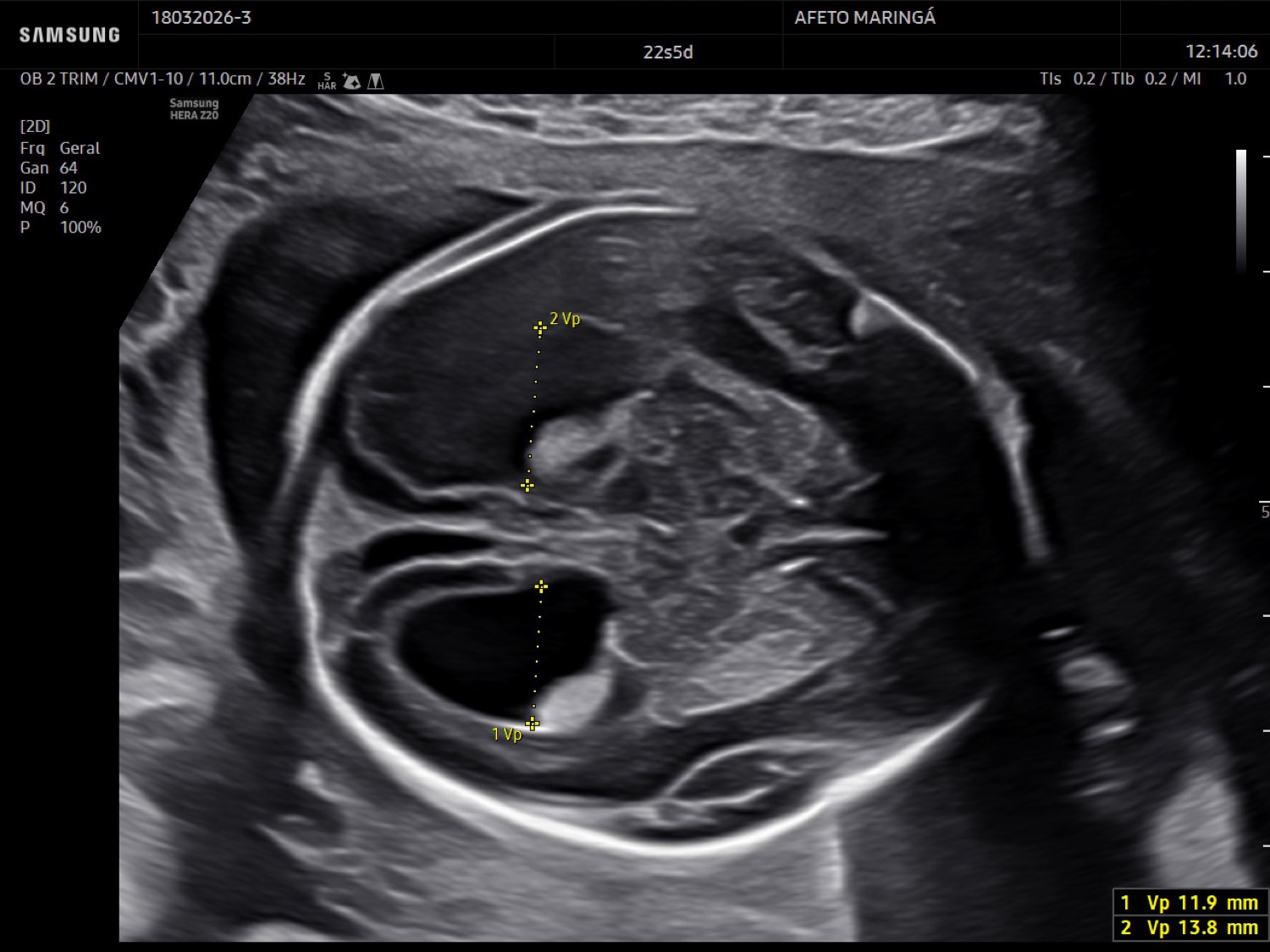 Ventriculomegalia fetal: o que significa esse achado no ultrassom?