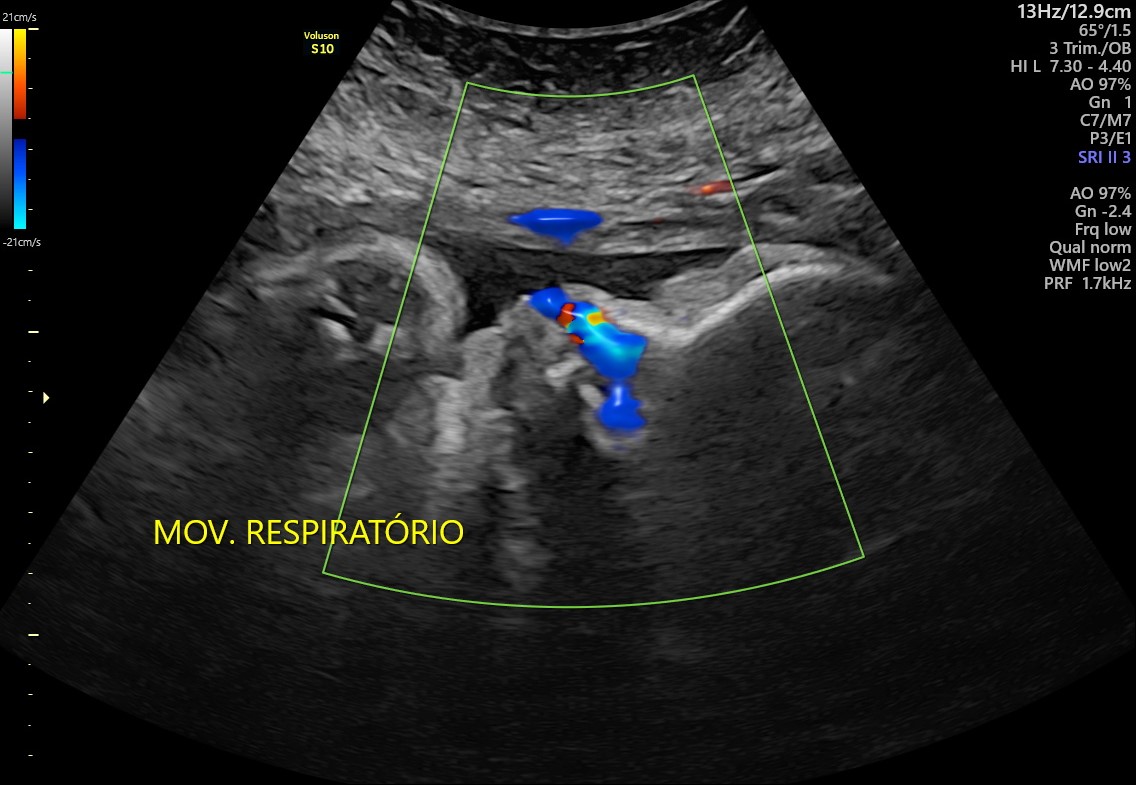 Ultrassom Obstétrico Com Perfil Biofísico Fetal (PBF ...